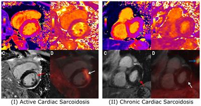 Recent advances in PET-MRI for cardiac sarcoidosis